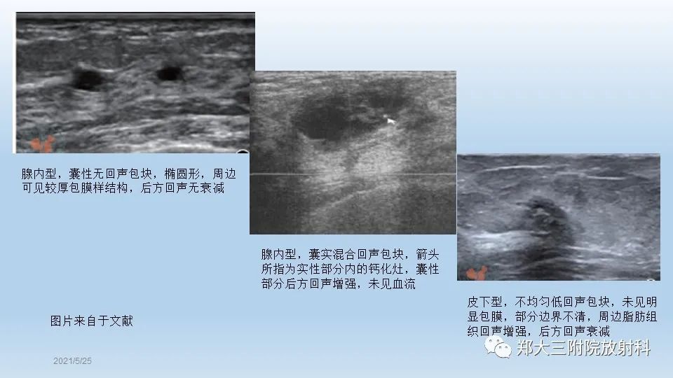 影像PPT - 【PPT】乳腺脂肪坏死影像学表现-8
