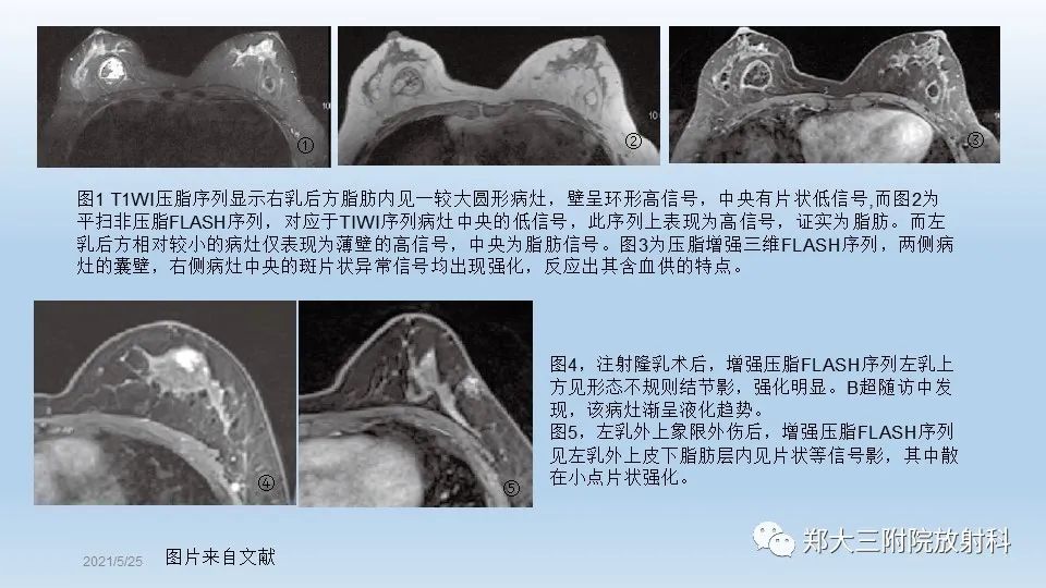 影像PPT - 【PPT】乳腺脂肪坏死影像学表现-13