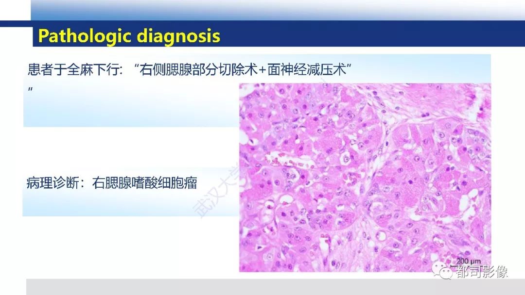 影像PPT - 【PPT】腮腺嗜酸细胞瘤影像诊断-4