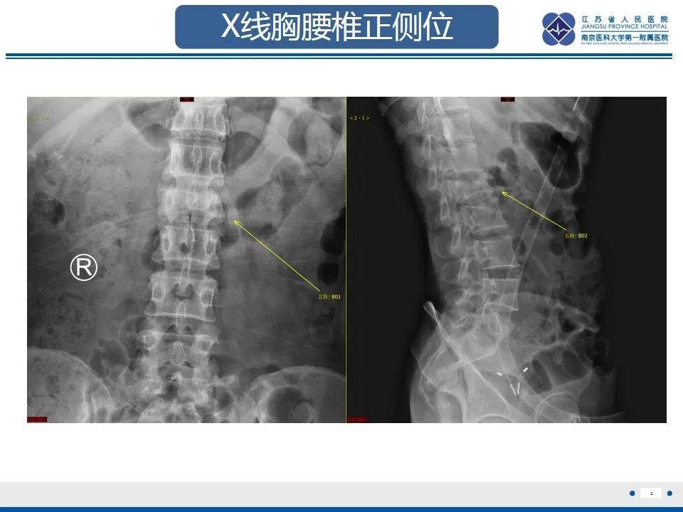 影像PPT - 【PPT】脊柱爆裂性骨折-3
