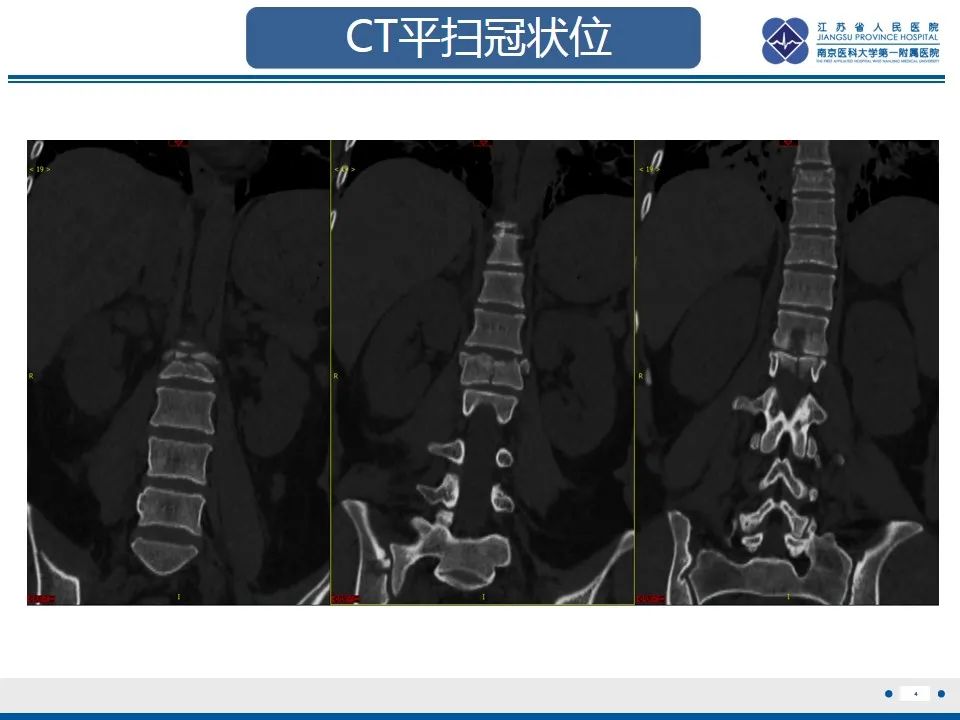 影像PPT - 【PPT】脊柱爆裂性骨折-5