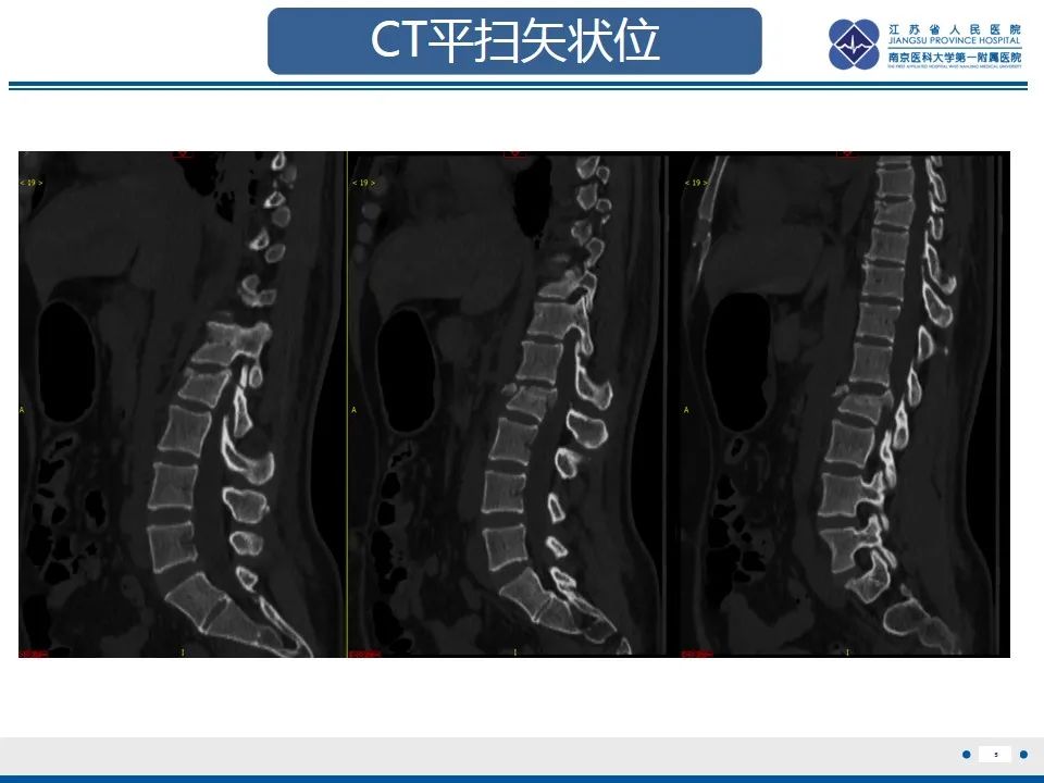 影像PPT - 【PPT】脊柱爆裂性骨折-6