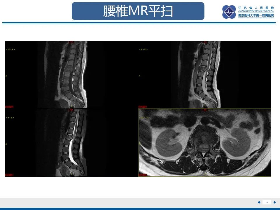 影像PPT - 【PPT】脊柱爆裂性骨折-7
