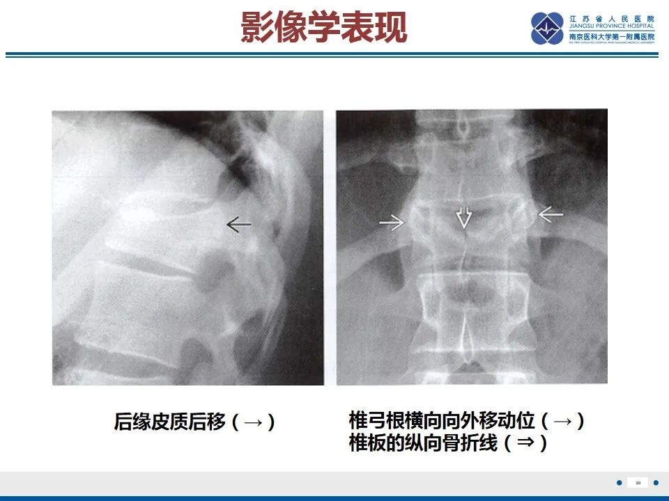 影像PPT - 【PPT】脊柱爆裂性骨折-21