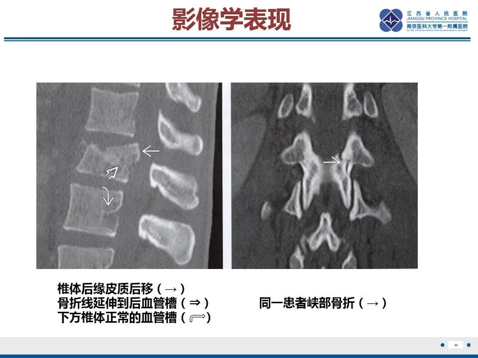 影像PPT - 【PPT】脊柱爆裂性骨折-23