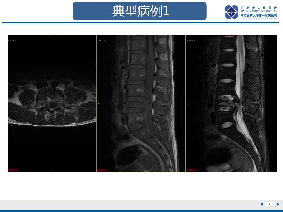 影像PPT - 【PPT】脊柱爆裂性骨折-27