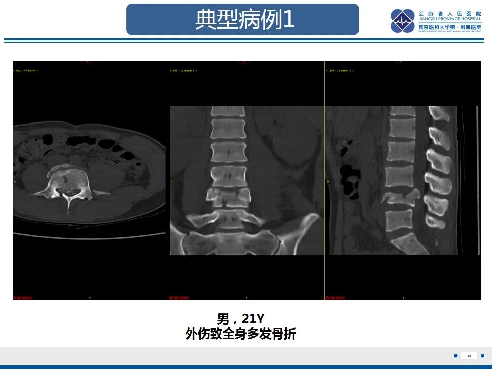 影像PPT - 【PPT】脊柱爆裂性骨折-26