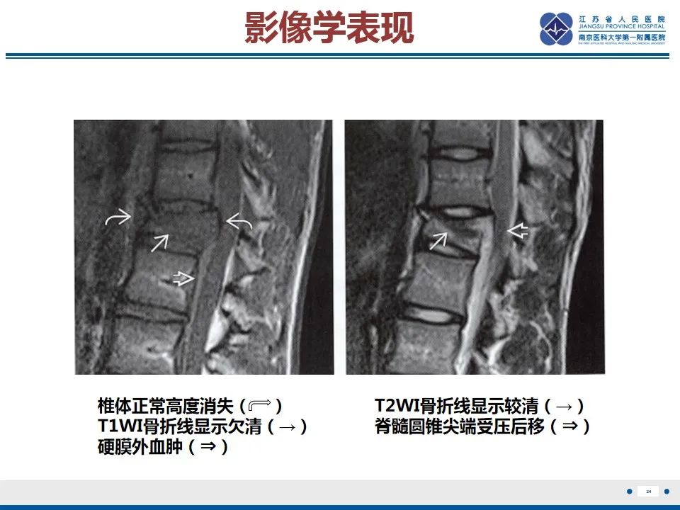 影像PPT - 【PPT】脊柱爆裂性骨折-25