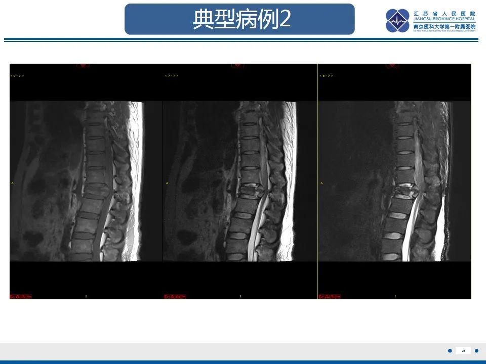 影像PPT - 【PPT】脊柱爆裂性骨折-29