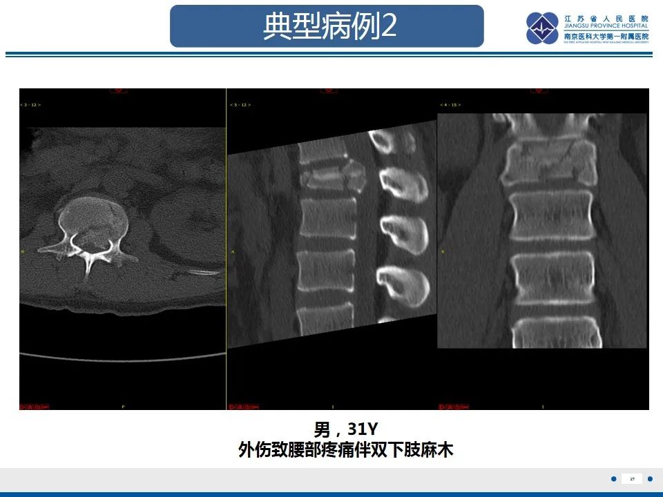 影像PPT - 【PPT】脊柱爆裂性骨折-28