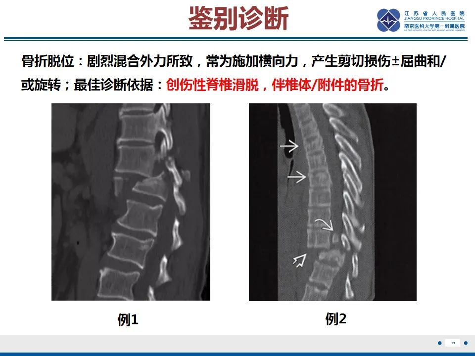 影像PPT - 【PPT】脊柱爆裂性骨折-36