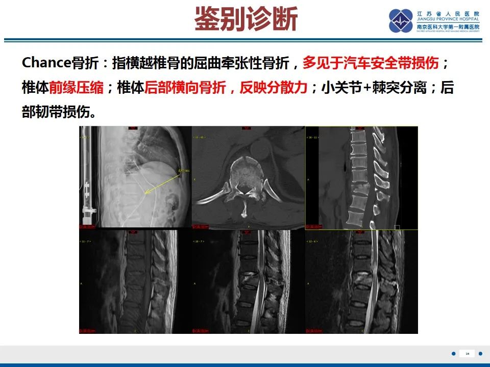 影像PPT - 【PPT】脊柱爆裂性骨折-35