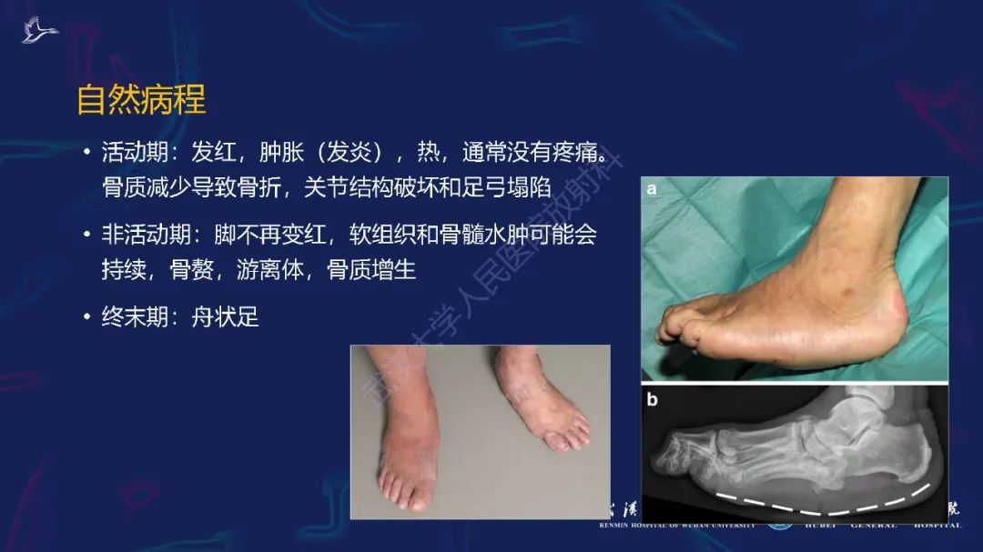 影像PPT - 【PPT】夏科氏足影像诊断-6