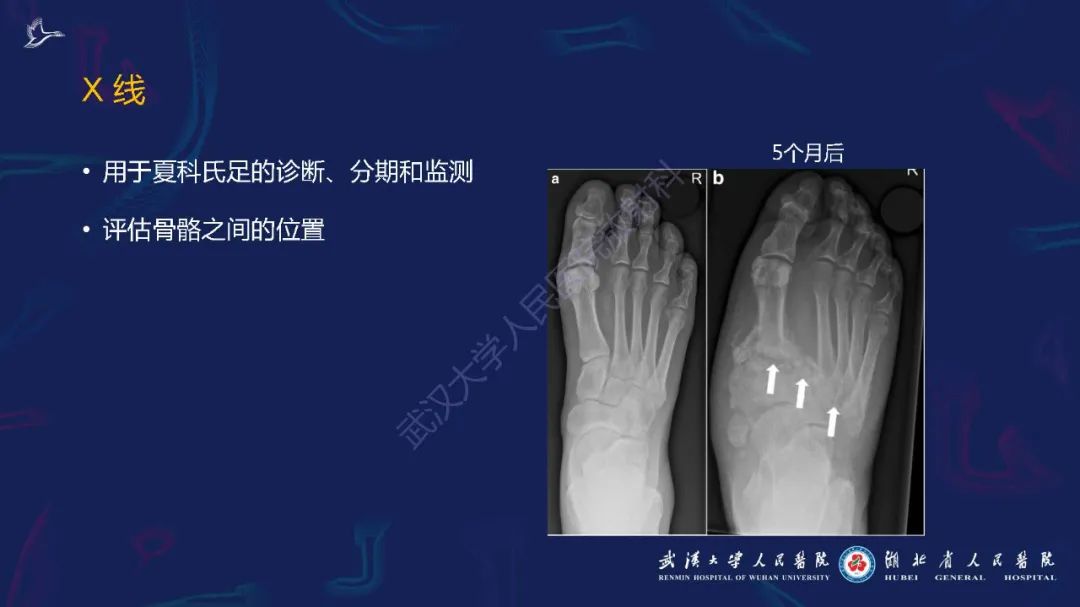 影像PPT - 【PPT】夏科氏足影像诊断-11