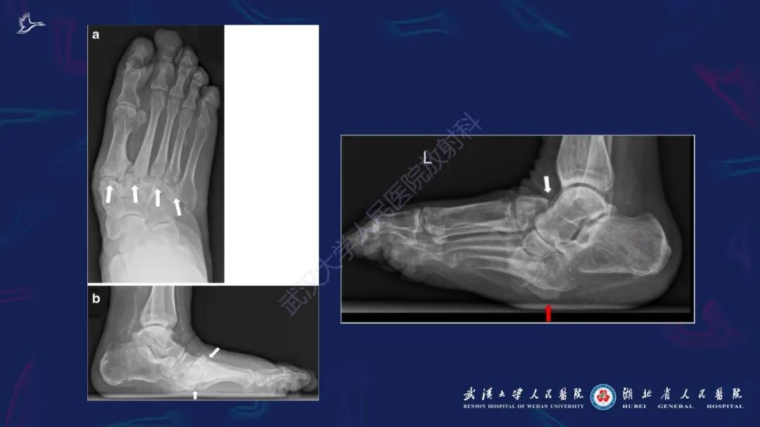 影像PPT - 【PPT】夏科氏足影像诊断-10