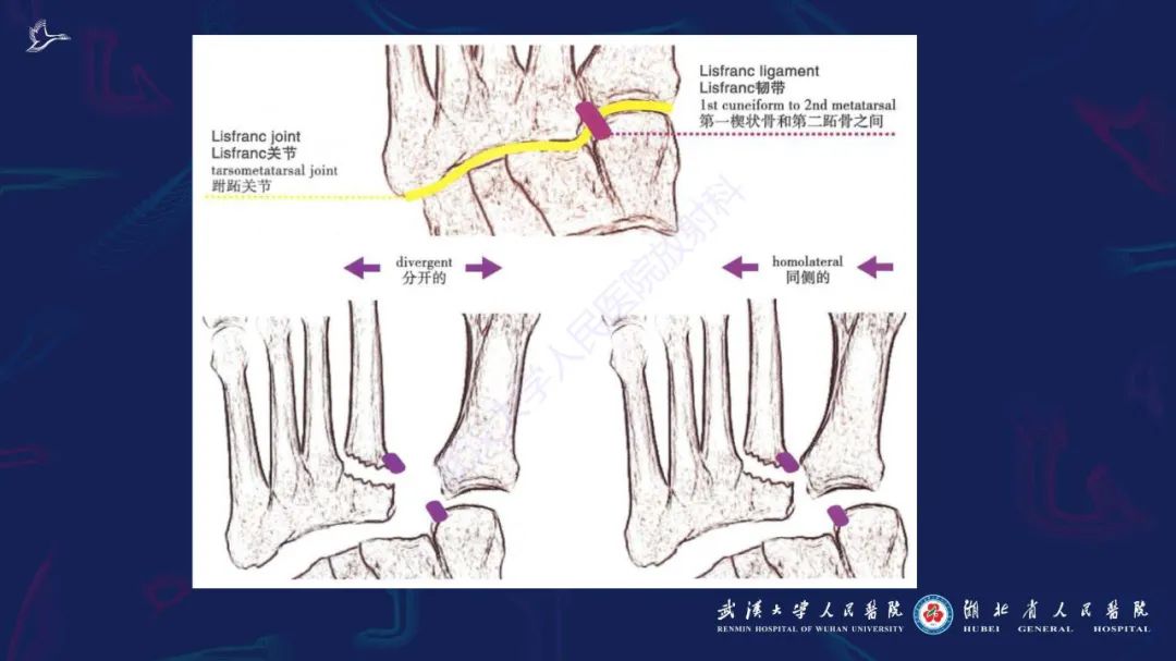 影像PPT - 【PPT】夏科氏足影像诊断-9
