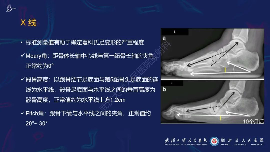 影像PPT - 【PPT】夏科氏足影像诊断-12
