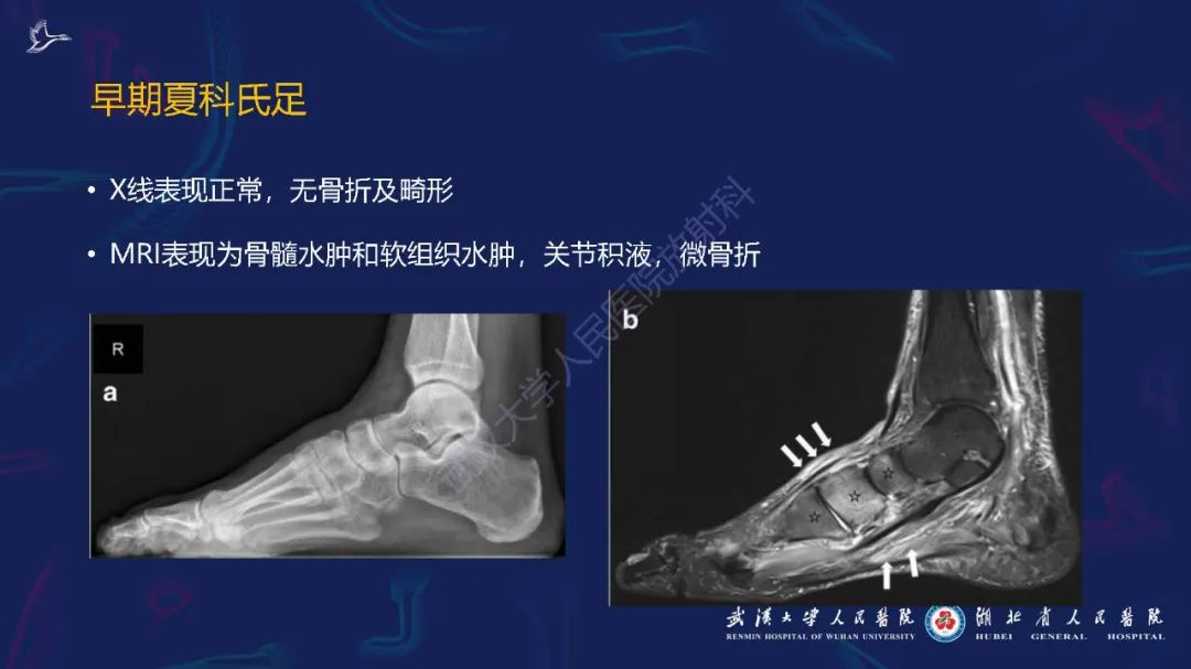 影像PPT - 【PPT】夏科氏足影像诊断-16