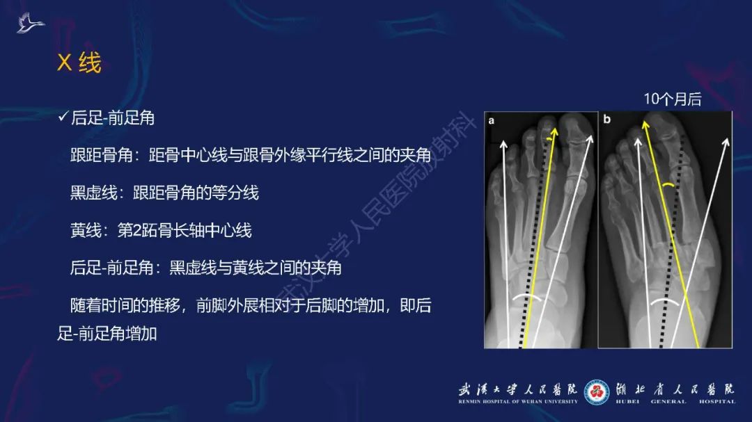 影像PPT - 【PPT】夏科氏足影像诊断-13