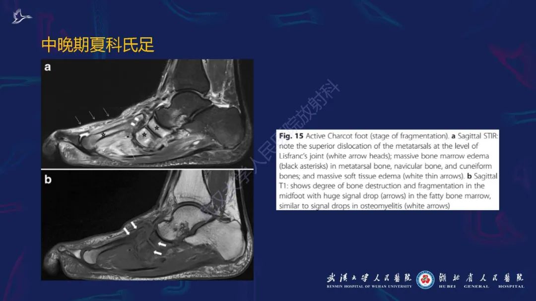 影像PPT - 【PPT】夏科氏足影像诊断-18