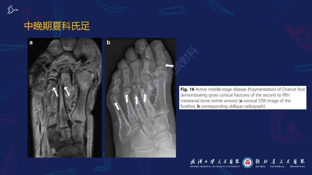影像PPT - 【PPT】夏科氏足影像诊断-19