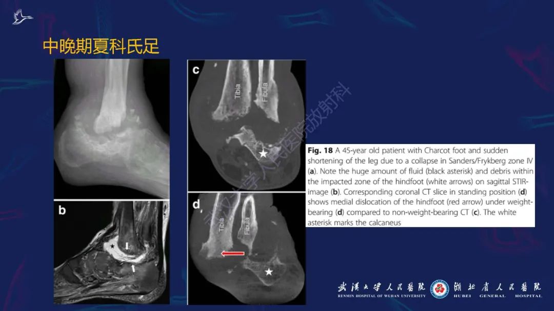 影像PPT - 【PPT】夏科氏足影像诊断-21