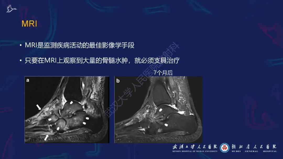 影像PPT - 【PPT】夏科氏足影像诊断-22