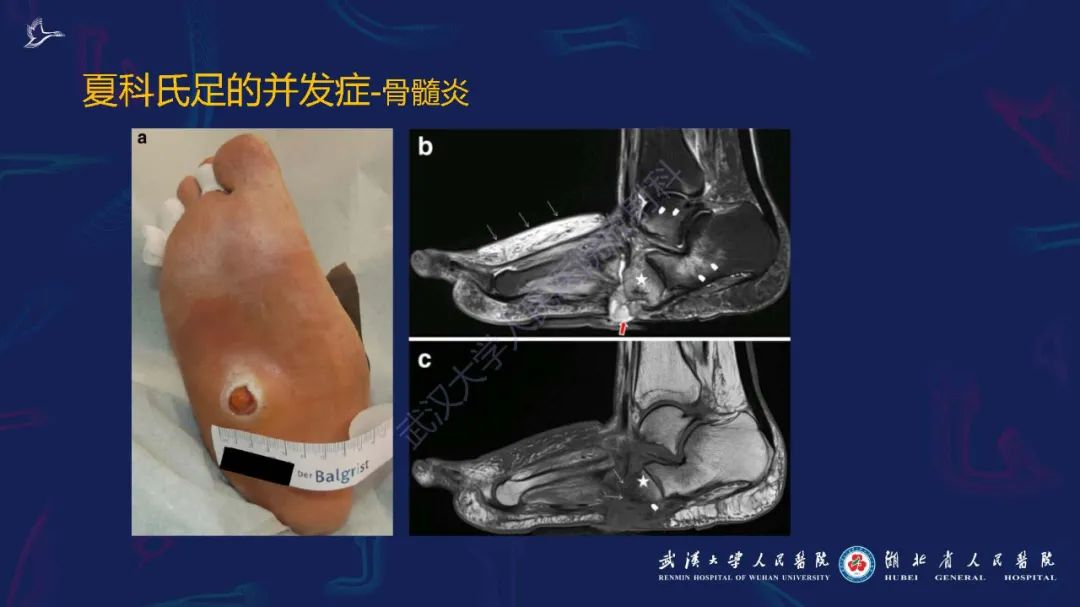 影像PPT - 【PPT】夏科氏足影像诊断-24