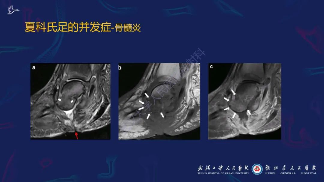 影像PPT - 【PPT】夏科氏足影像诊断-25