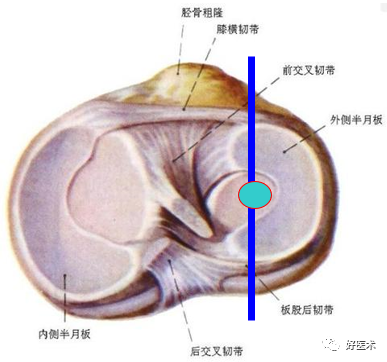 影像PPT - 半月板详细解剖及损伤的详细讲解-1 影像PPT - 半月板详细解剖及损伤的详细讲解-1
