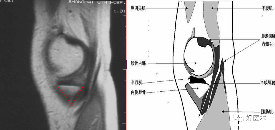 影像PPT - 半月板详细解剖及损伤的详细讲解-4 影像PPT - 半月板详细解剖及损伤的详细讲解-4