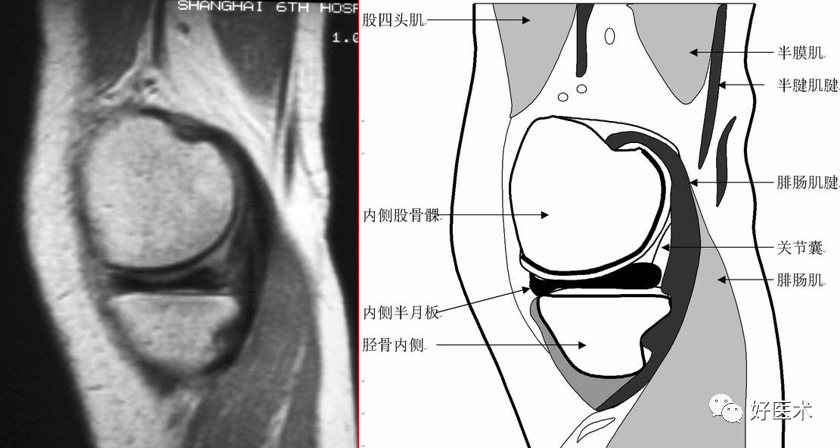 影像PPT - 半月板详细解剖及损伤的详细讲解-5 影像PPT - 半月板详细解剖及损伤的详细讲解-5