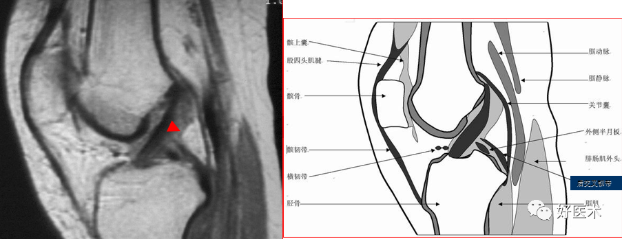 影像PPT - 半月板详细解剖及损伤的详细讲解-9 影像PPT - 半月板详细解剖及损伤的详细讲解-9