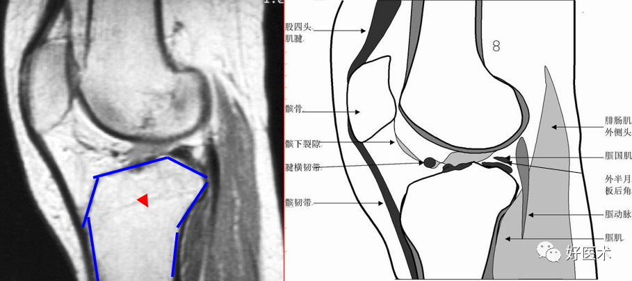 影像PPT - 半月板详细解剖及损伤的详细讲解-10 影像PPT - 半月板详细解剖及损伤的详细讲解-10