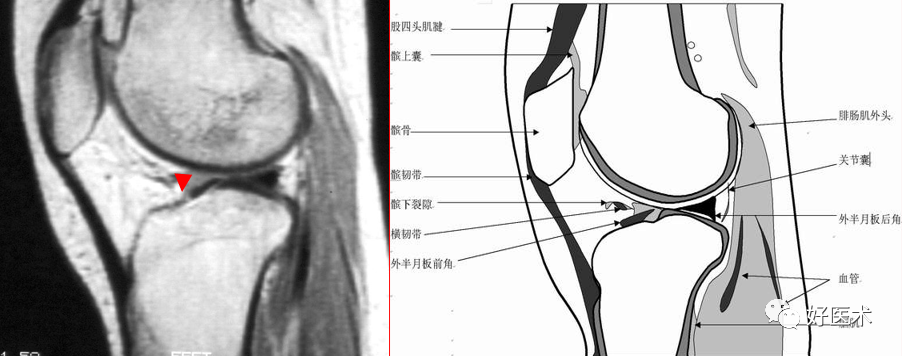 影像PPT - 半月板详细解剖及损伤的详细讲解-11 影像PPT - 半月板详细解剖及损伤的详细讲解-11