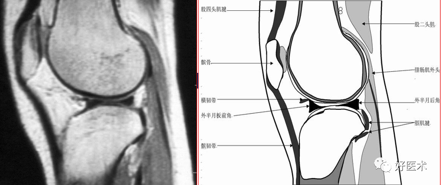 影像PPT - 半月板详细解剖及损伤的详细讲解-12 影像PPT - 半月板详细解剖及损伤的详细讲解-12