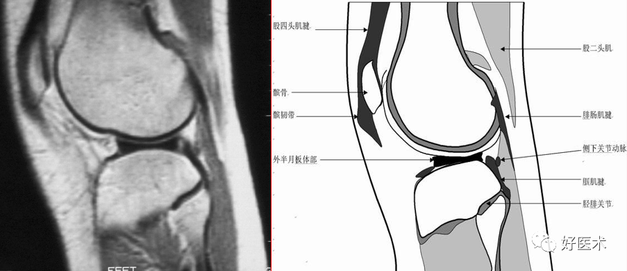 影像PPT - 半月板详细解剖及损伤的详细讲解-13 影像PPT - 半月板详细解剖及损伤的详细讲解-13