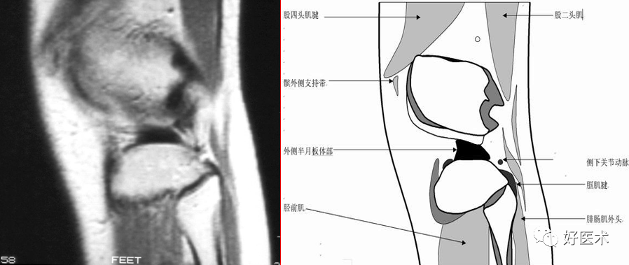 影像PPT - 半月板详细解剖及损伤的详细讲解-14 影像PPT - 半月板详细解剖及损伤的详细讲解-14