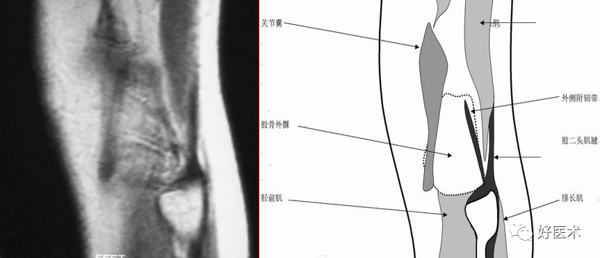 影像PPT - 半月板详细解剖及损伤的详细讲解-15 影像PPT - 半月板详细解剖及损伤的详细讲解-15