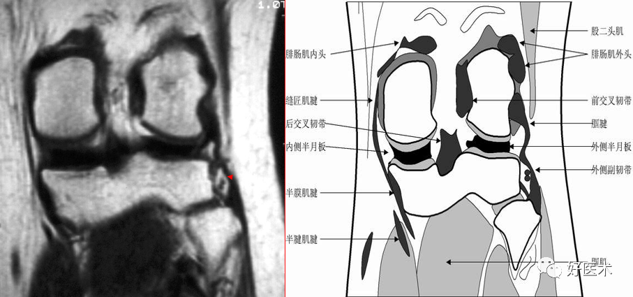 影像PPT - 半月板详细解剖及损伤的详细讲解-17 影像PPT - 半月板详细解剖及损伤的详细讲解-17