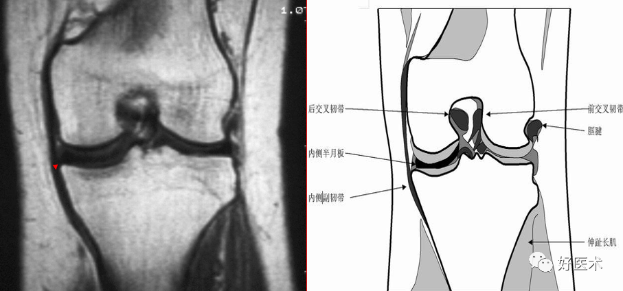 影像PPT - 半月板详细解剖及损伤的详细讲解-19 影像PPT - 半月板详细解剖及损伤的详细讲解-19