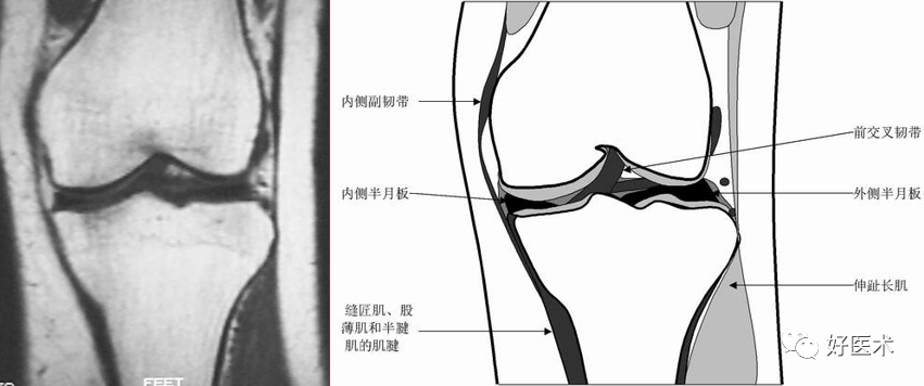 影像PPT - 半月板详细解剖及损伤的详细讲解-21 影像PPT - 半月板详细解剖及损伤的详细讲解-21