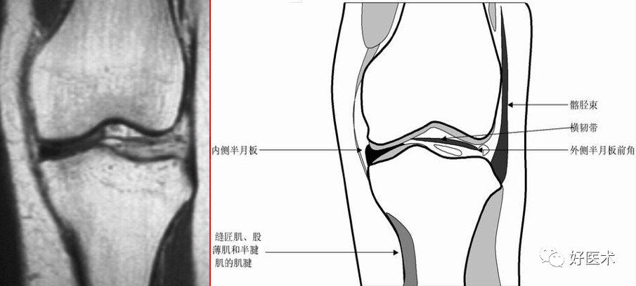 影像PPT - 半月板详细解剖及损伤的详细讲解-22 影像PPT - 半月板详细解剖及损伤的详细讲解-22