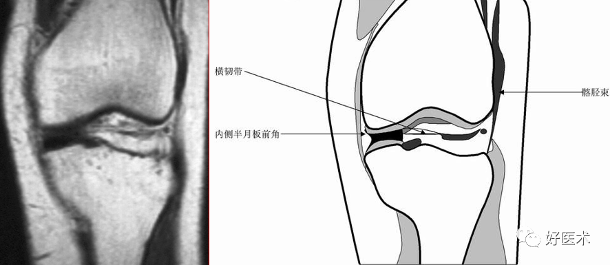 影像PPT - 半月板详细解剖及损伤的详细讲解-23 影像PPT - 半月板详细解剖及损伤的详细讲解-23
