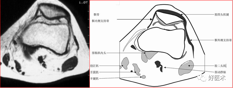影像PPT - 半月板详细解剖及损伤的详细讲解-25 影像PPT - 半月板详细解剖及损伤的详细讲解-25
