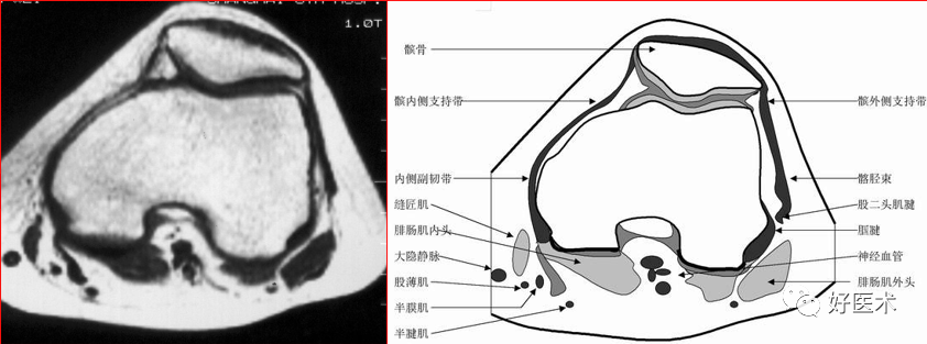 影像PPT - 半月板详细解剖及损伤的详细讲解-27 影像PPT - 半月板详细解剖及损伤的详细讲解-27