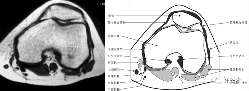 影像PPT - 半月板详细解剖及损伤的详细讲解-28 影像PPT - 半月板详细解剖及损伤的详细讲解-28