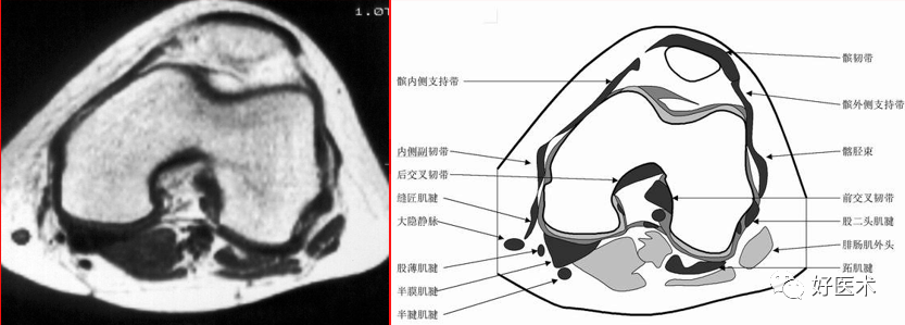 影像PPT - 半月板详细解剖及损伤的详细讲解-29 影像PPT - 半月板详细解剖及损伤的详细讲解-29