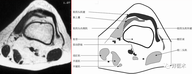 影像PPT - 半月板详细解剖及损伤的详细讲解-24 影像PPT - 半月板详细解剖及损伤的详细讲解-24