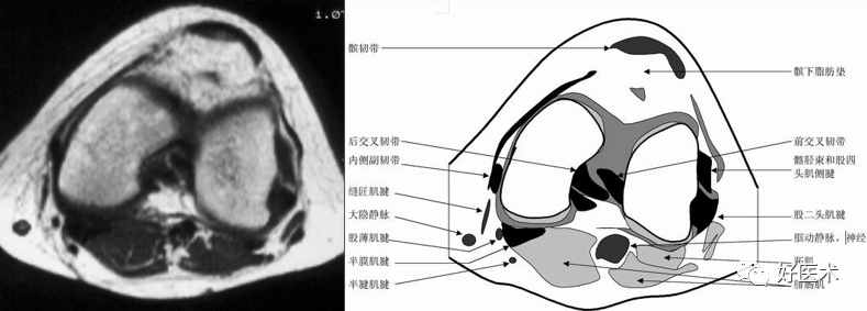 影像PPT - 半月板详细解剖及损伤的详细讲解-30 影像PPT - 半月板详细解剖及损伤的详细讲解-30